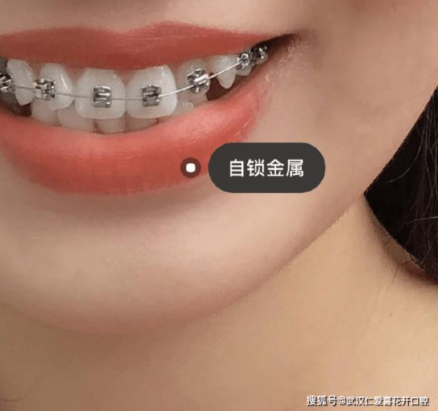 網友:年齡大了還能矯正嗎?武漢仁愛口腔醫師告訴你:整牙任何時候都不晚!