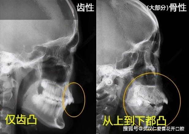 “一張嘴毀掉所有”的突嘴,該如何拯救?武漢仁愛口腔牙齒矯正讓你瞬間綻放笑容!