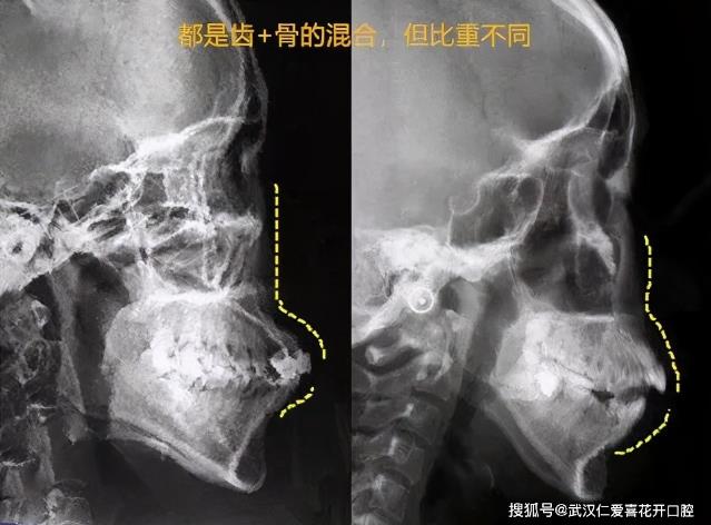 “一張嘴毀掉所有”的突嘴,該如何拯救?武漢仁愛口腔牙齒矯正讓你瞬間綻放笑容!