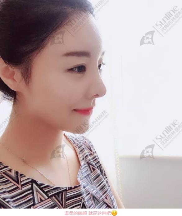 沈陽杏林整形隆鼻費用貴嗎 效果好不好