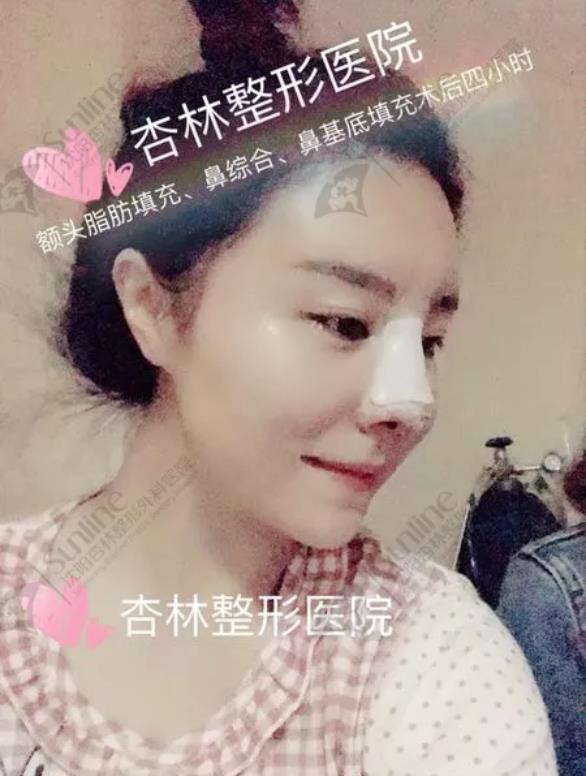沈陽杏林整形隆鼻費用貴嗎 效果好不好