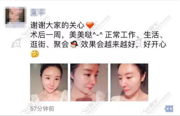 沈陽杏林整形隆鼻費用貴嗎 效果好不好