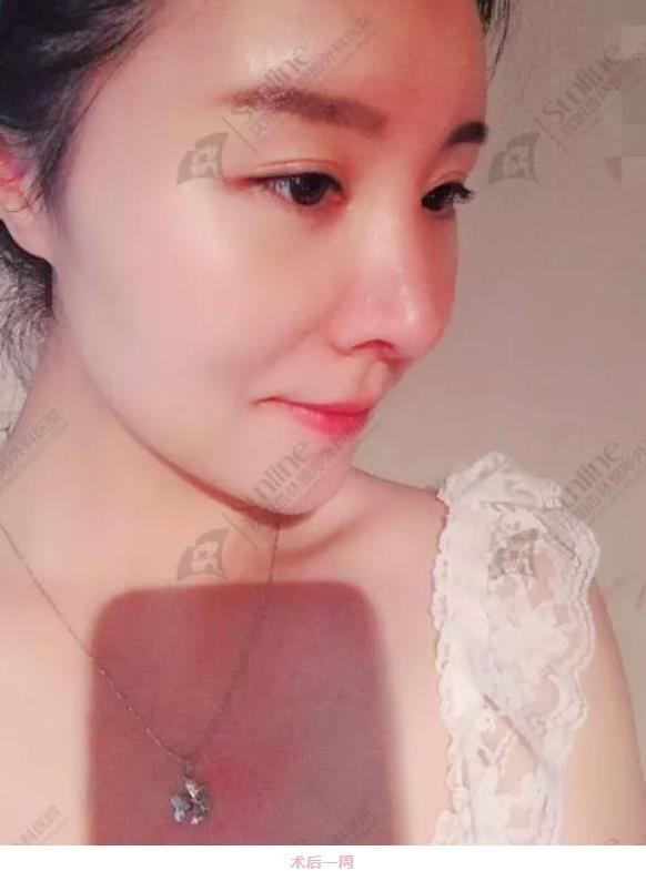 沈陽杏林整形隆鼻費用貴嗎 效果好不好