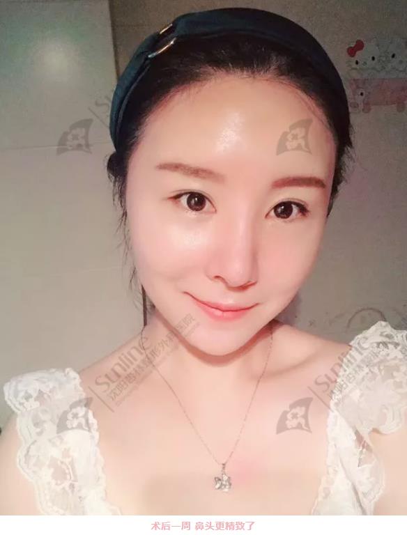 沈陽杏林整形隆鼻費用貴嗎 效果好不好