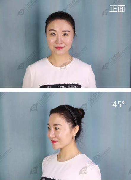沈陽杏林整形隆鼻費用貴嗎 效果好不好
