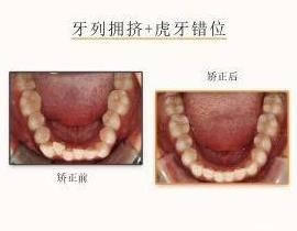 網友:牙齒不齊想矯正但又不想拔牙該怎么治療?仁愛口腔醫師表示不拔牙也能讓你擁有一副微笑臉!