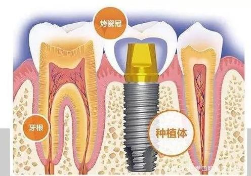 網(wǎng)友:缺牙怎么辦?武漢仁愛口腔種植專家?guī)睋舴N植手術(shù)現(xiàn)場,見證缺牙重生的秘密!