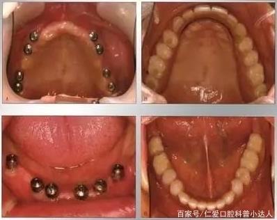 網(wǎng)友:缺牙怎么辦?武漢仁愛口腔種植專家?guī)睋舴N植手術(shù)現(xiàn)場,見證缺牙重生的秘密!