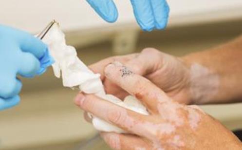 為什么男性白癜風更容易擴散?新軍都醫(yī)院男性白癜風診療專家趙河臣主任總結了這些原因