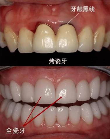 武漢仁愛口腔全瓷牙效果如何?能用多久?有什么優勢?
