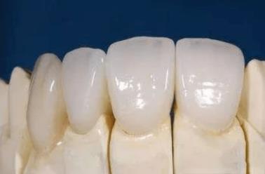 武漢仁愛口腔全瓷牙效果如何?能用多久?有什么優勢?