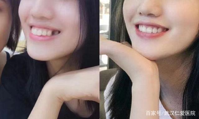 武漢仁愛口腔種牙怎么樣?靠譜嗎?網(wǎng)友感慨:30而已,竟然加入種牙大軍?!
