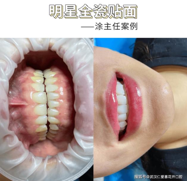 武漢仁愛口腔醫院正規嗎?網友好評:根管治療、牙齒美白、全瓷貼面...安心可靠!