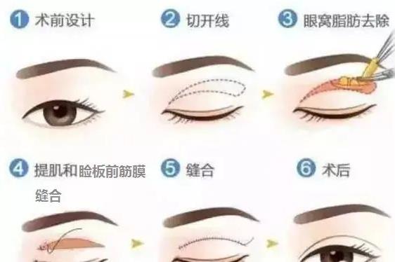 北京蘇亞醫美解答:第二次做雙眼皮屬于修復嗎?