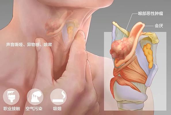 成都民生耳鼻喉醫院 多年聲嘶,喝酒抽煙又熬夜是怎么回事