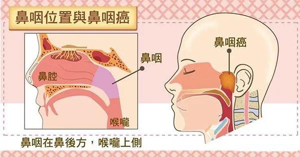 成都民生耳鼻喉專科醫院陳建超教授解答 鼻咽癌怎么治
