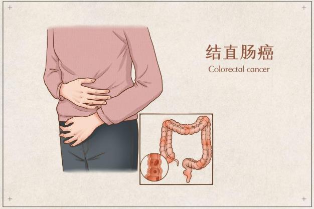 泰萊生物助力結直腸癌篩查診斷提高準確性