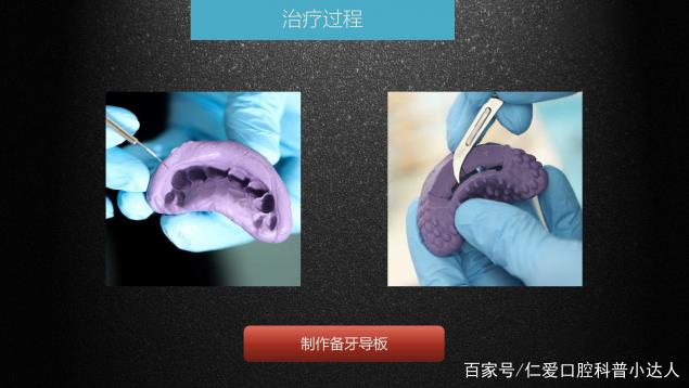 武漢仁愛口腔 數字化即刻美學貼面案例分享