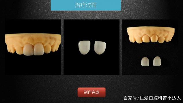 武漢仁愛口腔 數字化即刻美學貼面案例分享