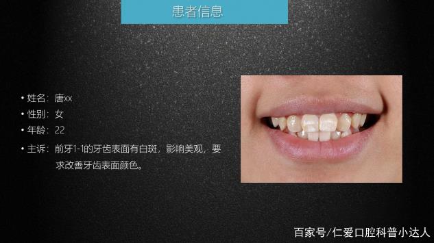 武漢仁愛口腔 數字化即刻美學貼面案例分享