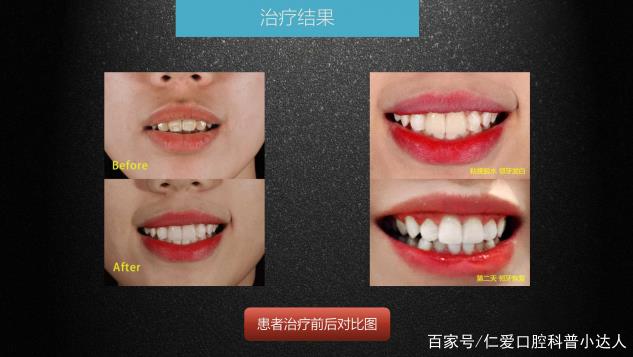 武漢仁愛口腔 數字化即刻美學貼面案例分享