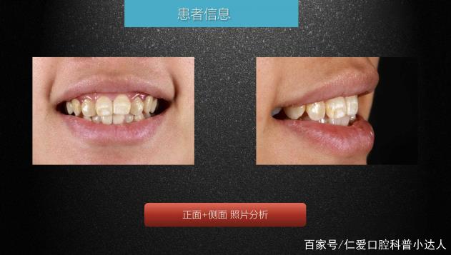 武漢仁愛口腔 數字化即刻美學貼面案例分享