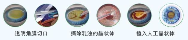 北京華德眼科醫院:別拖了!秋天是做白內障手術的黃金季節。