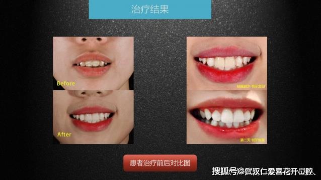 武漢仁愛口腔 數(shù)字化即刻美學(xué)貼面案例分享