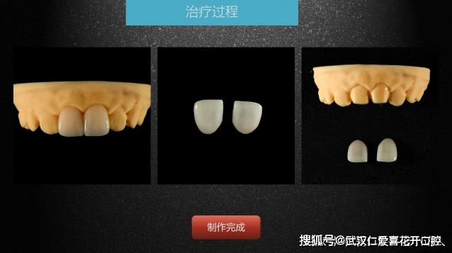 武漢仁愛口腔 數(shù)字化即刻美學(xué)貼面案例分享