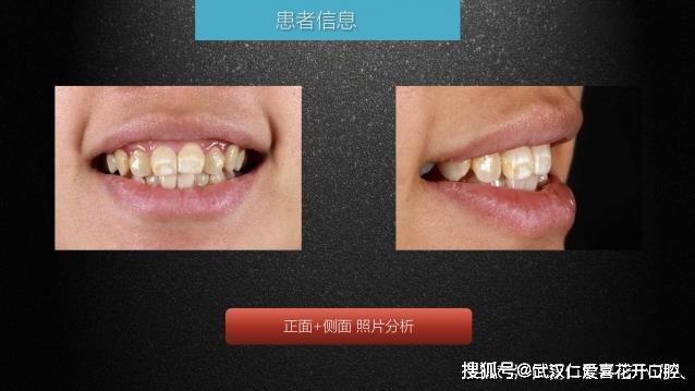 武漢仁愛口腔 數(shù)字化即刻美學(xué)貼面案例分享
