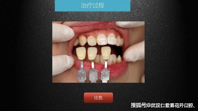 武漢仁愛口腔 數(shù)字化即刻美學(xué)貼面案例分享