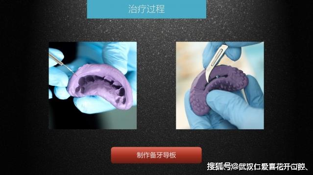 武漢仁愛口腔 數(shù)字化即刻美學(xué)貼面案例分享