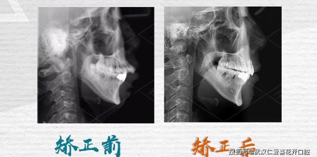 武漢仁愛口腔即刻開始,為時未晚:45歲也能成功蛻變!國慶矯正預約爆滿!