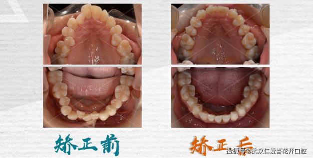 武漢仁愛口腔即刻開始,為時未晚:45歲也能成功蛻變!國慶矯正預約爆滿!