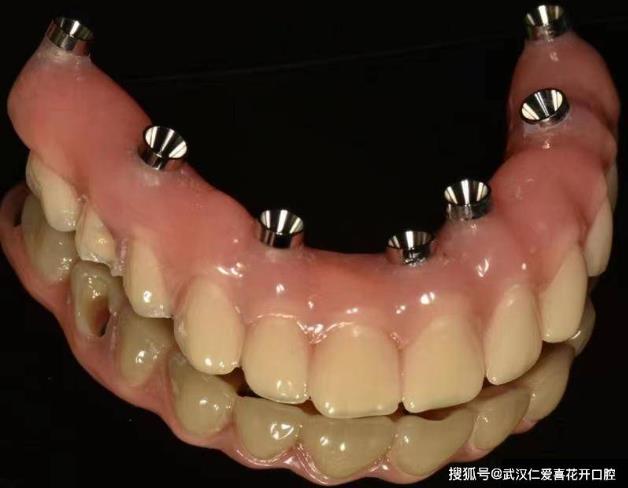 武漢仁愛口腔典型重度牙周炎種植案例:實現即刻種植與即刻修復