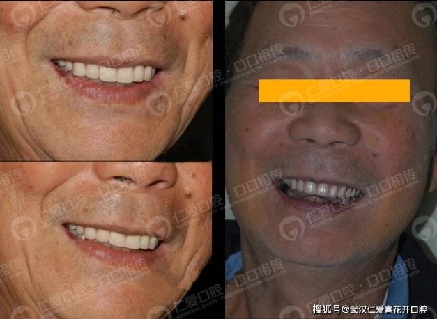 武漢仁愛口腔典型重度牙周炎種植案例:實現即刻種植與即刻修復