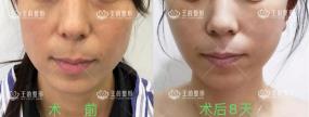 45歲后我開始研究起了“王的整形內(nèi)窺鏡駐顏術(shù)”