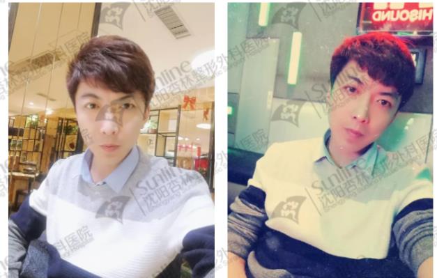 沈陽杏林整形外科醫院:下頜后縮怎么辦