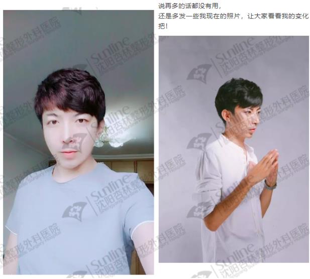 沈陽杏林整形外科醫院:下頜后縮怎么辦