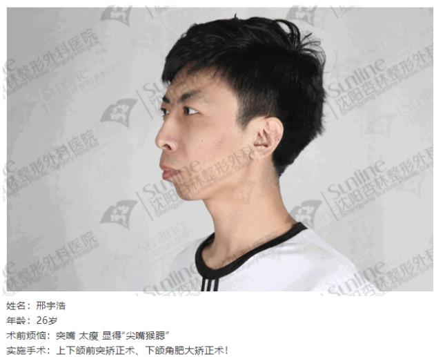 沈陽杏林整形外科醫院:下頜后縮怎么辦