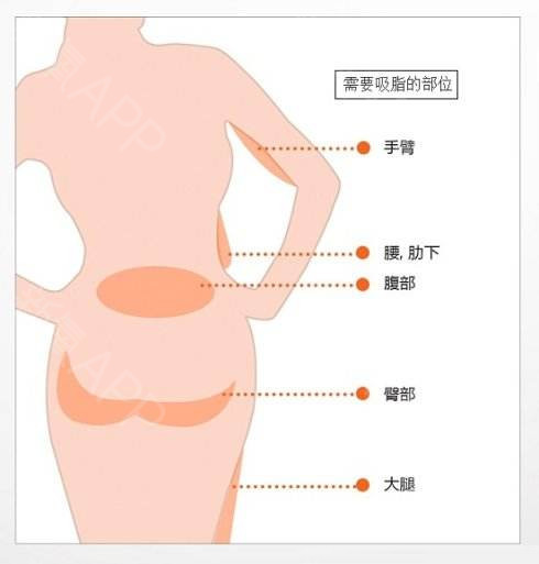 劉靖濤醫(yī)生劃重點(diǎn):為什么有人做完腰腹吸脂效果好,有人做完變化不大?