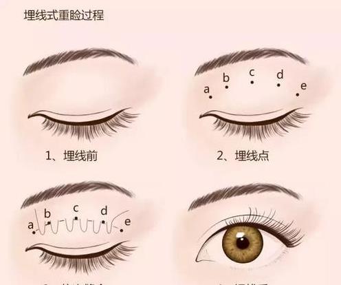 聽(tīng)聽(tīng)王的整形王海木院長(zhǎng)分享雙眼皮避坑指南