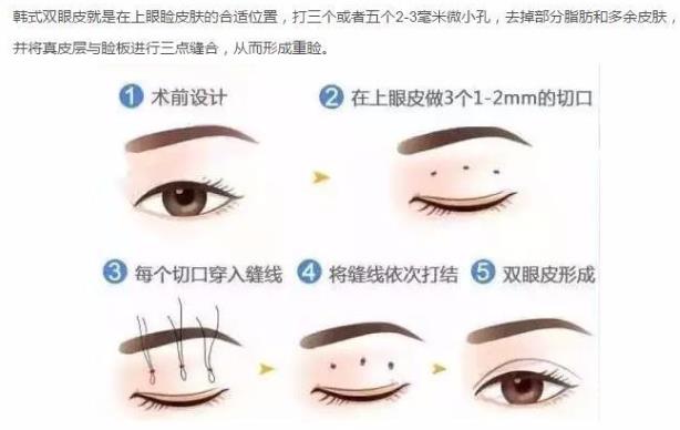 聽(tīng)聽(tīng)王的整形王海木院長(zhǎng)分享雙眼皮避坑指南