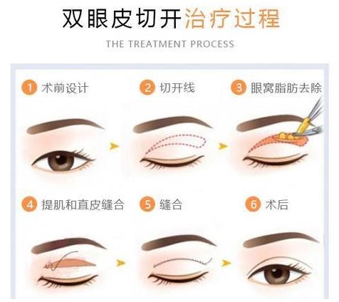 聽(tīng)聽(tīng)王的整形王海木院長(zhǎng)分享雙眼皮避坑指南