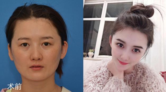 聽(tīng)聽(tīng)王的整形王海木院長(zhǎng)分享雙眼皮避坑指南
