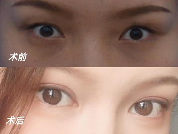 聽(tīng)聽(tīng)王的整形王海木院長(zhǎng)分享雙眼皮避坑指南