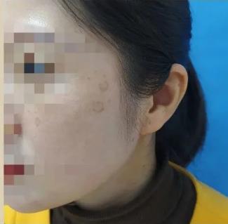 花還開科技祛斑:熬夜長老年斑只是謠言?!