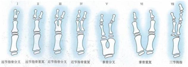 順德和平醫院手指再造還原 六指多指孩子手足畸形,過早手術有哪些好處?