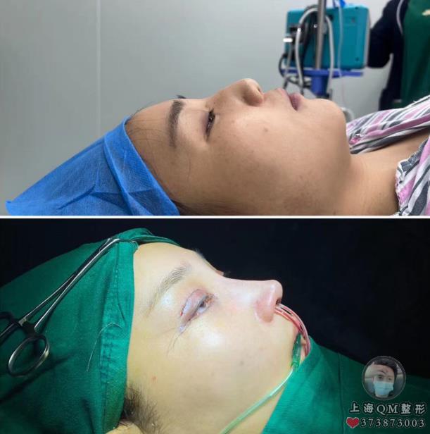 上海徐麗芬整形醫(yī)生關于整形肋骨鼻的相關問答