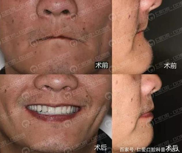 缺一顆牙的危害有多大?武漢仁愛口腔種牙靠譜嗎?貴嗎?缺1顆連累全口!有了它,60歲大叔生活重放光彩!